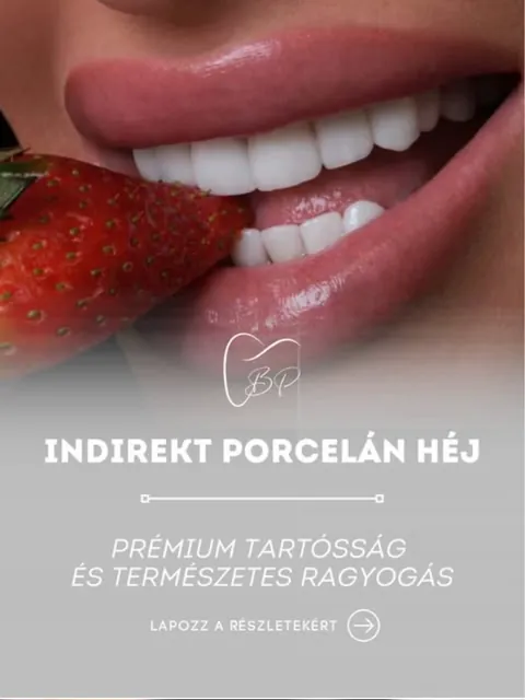 Bp Esztétikai Fogászat Instagram: Indirekt porcelán héj, mosoly eperrel